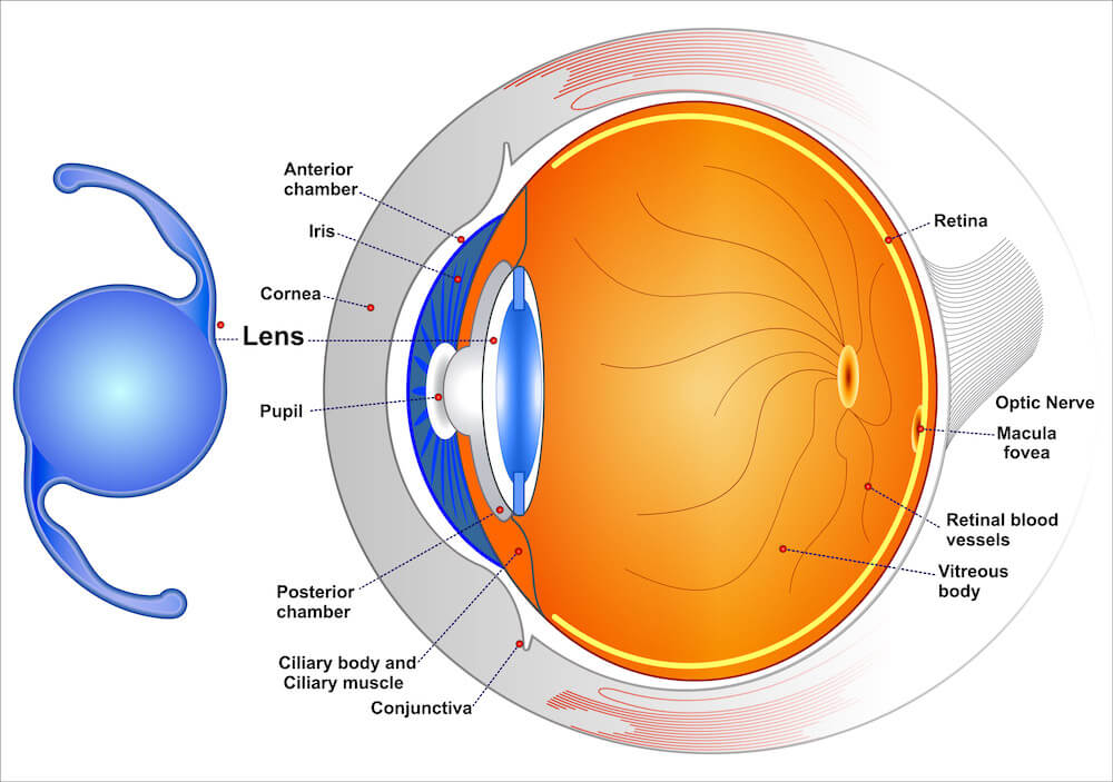 Diagram showing how an advanced lens helps with cataracts