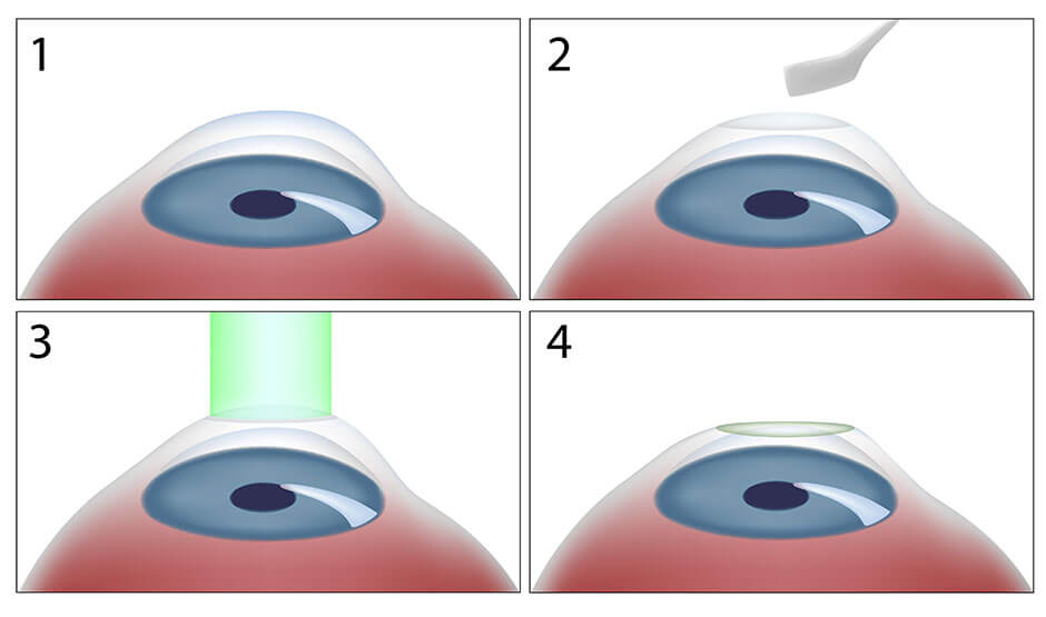 Diagram showing PRK procedure