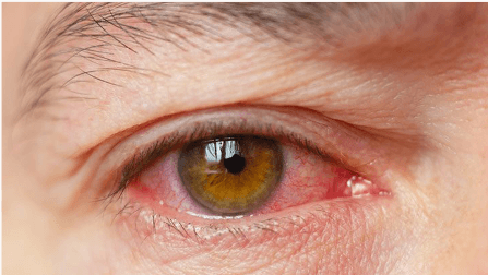 Closeup of a dry, red eye