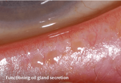 Closeup of eye oil gland secretion