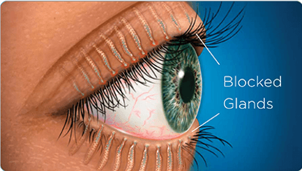 Illustration of eye with blocked glands