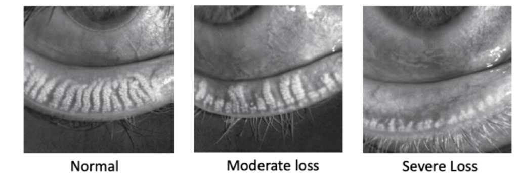 LipiView images showing the progression of Meibomian Gland Dysfunction