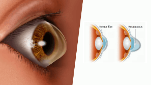 illustration of normal eye and keratoconus